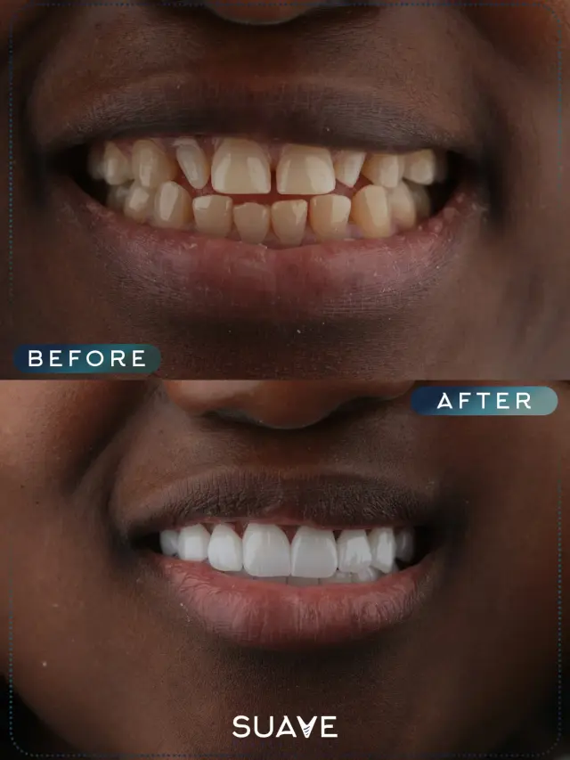 Dental implants turkey before and after - Patient 1