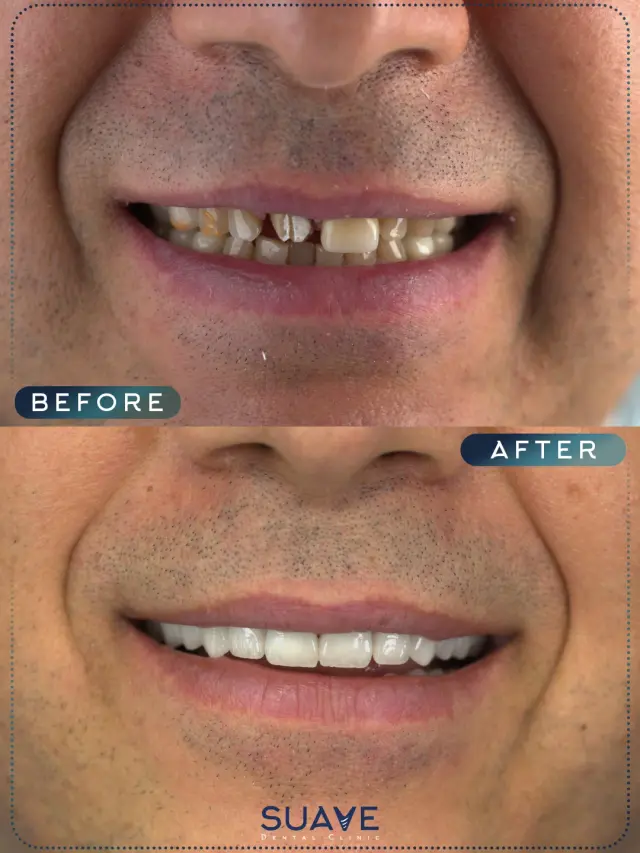 Turkey teeth implants before after - Patient 2