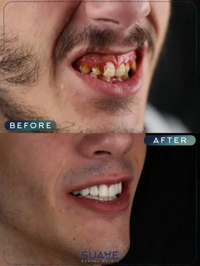 Turkish dental implants results - Patient 3