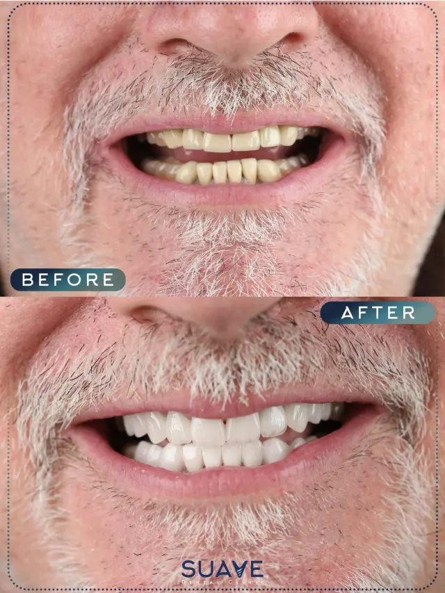 Implants in turkey before and after - Patient 4