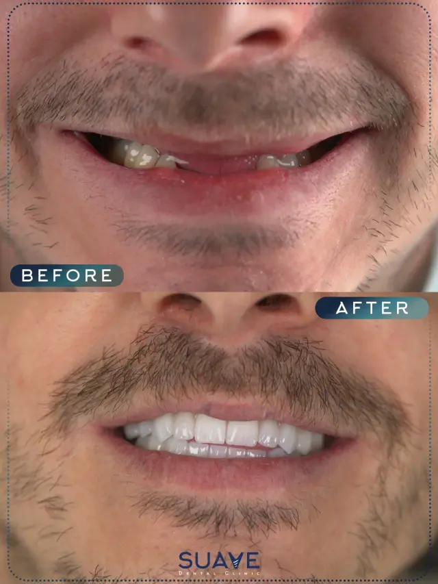 All on 4 dental implants turkey results - Patient 5