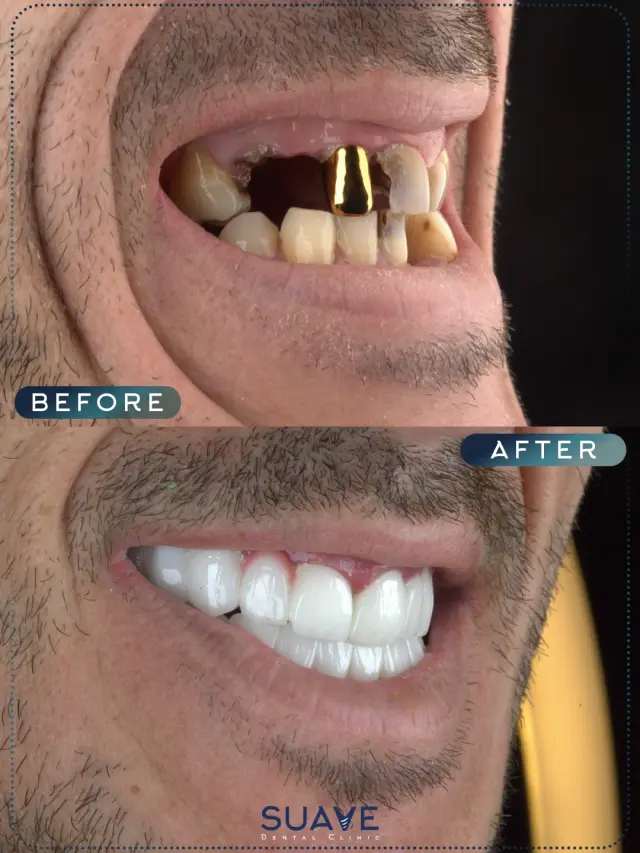 Full mouth dental implants turkey before after - Patient 6