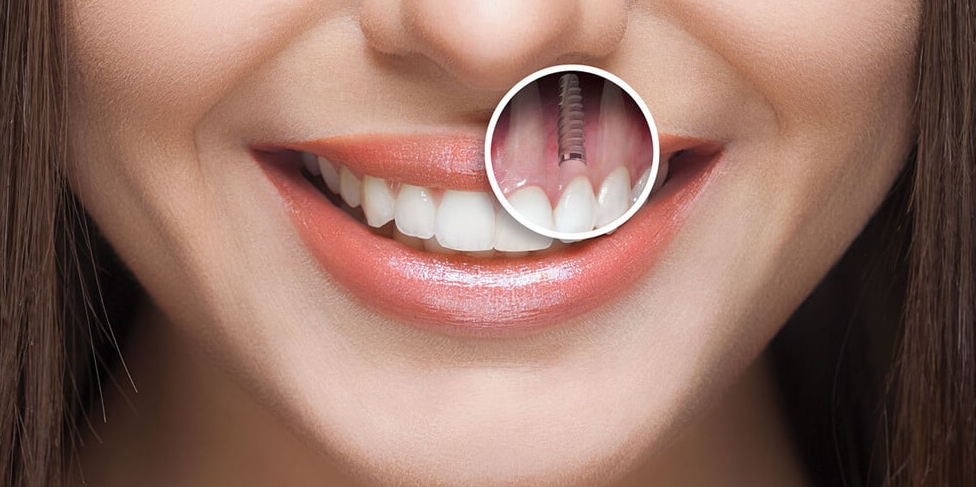 All-on-4 dental implant illustration showing angled placement