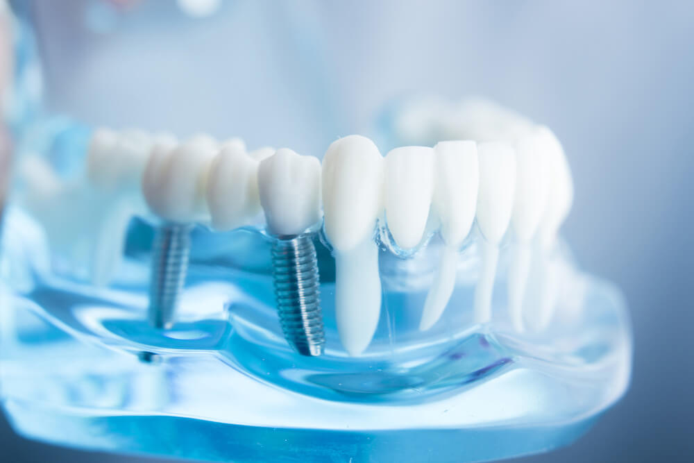 All-on-4 dental implants in Turkey