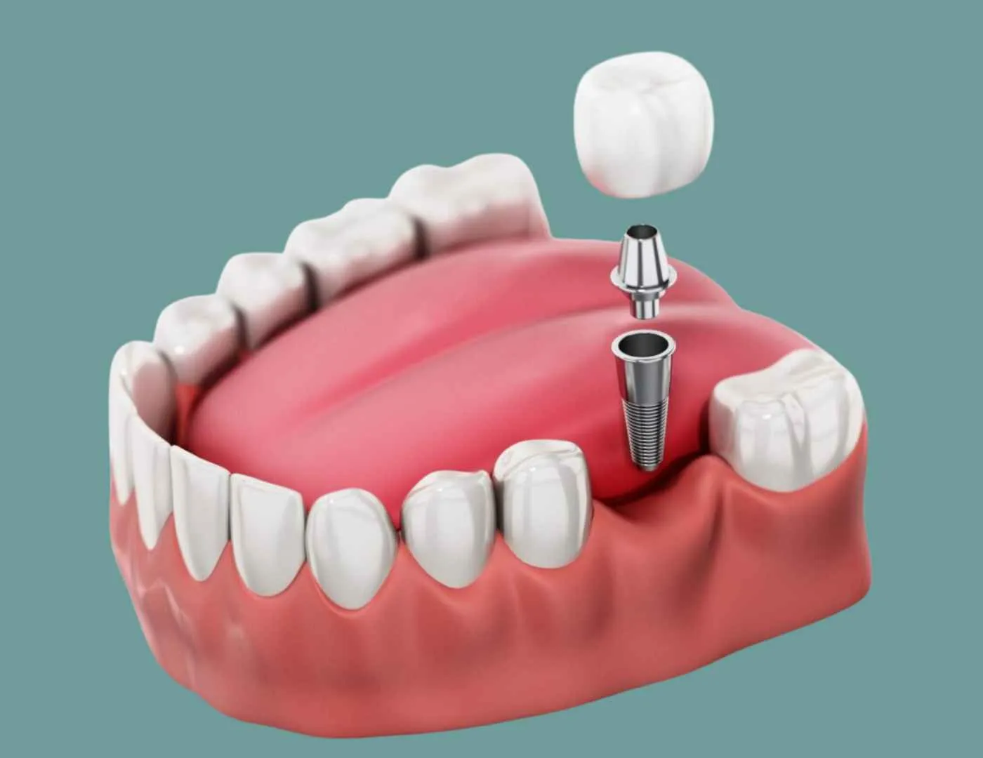 Single tooth dental implant in Turkey