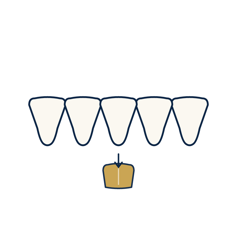 Dental veneers in Turkey